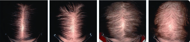 prednisone-hair-loss-recovery